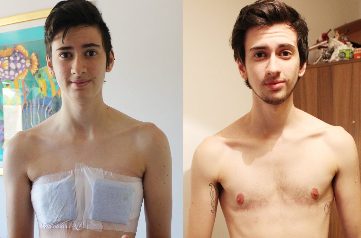 Transgender Life After Surgery