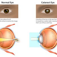 Can cataracts be reversed without surgery?